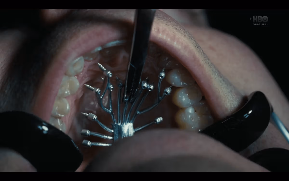 03 Aplikace Implantátu sloužícího k následné modulaci vědomí